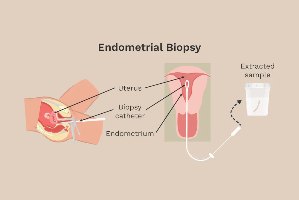 Endometrial Biopsy at Srishti Women & Child Clinic — Ramamurthy Nagar, Bengaluru