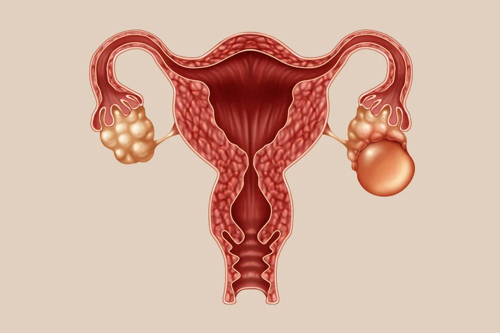 Fibroids & Ovarian Cysts at Srishti Women & Child Clinic — Ramamurthy Nagar, Bengaluru