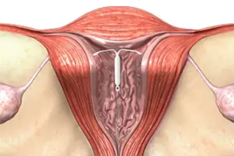 Contraception – IUD & Mirena at Srishti Women & Child Clinic, Ramamurthy Nagar, Bengaluru